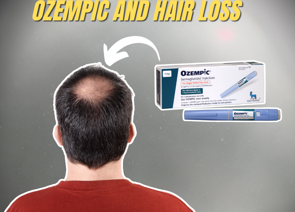 Possible Connection Between Ozempic and Hair Loss